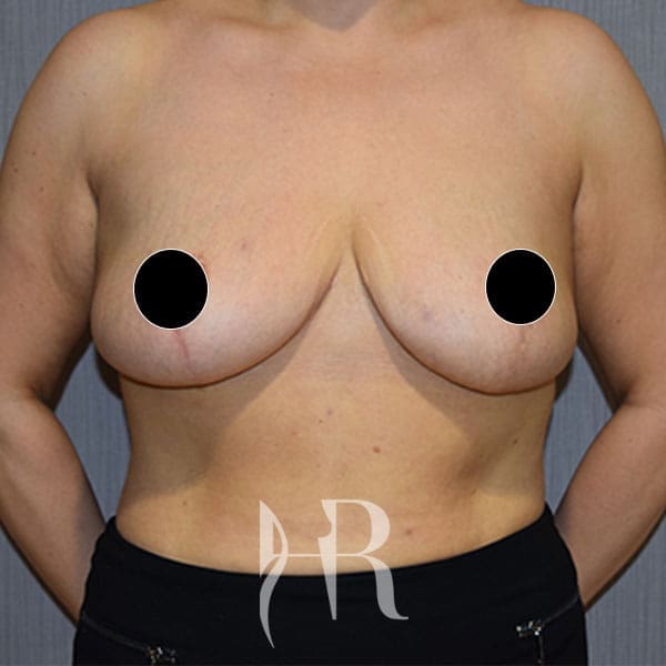 HR Plastic Surgery - Breast Reduction patient after 7